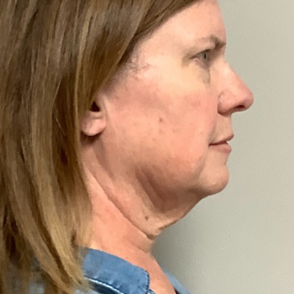 HourLift Before & After Patient #10700