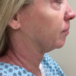 Neck Lift Before & After Patient #10659