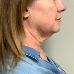 Neck Liposuction Before & After Patient #10705