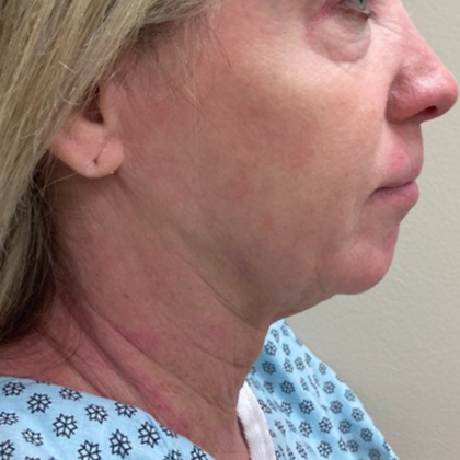 Neck Lift Before & After Patient #10659
