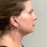 HourLift Before & After Patient #10700