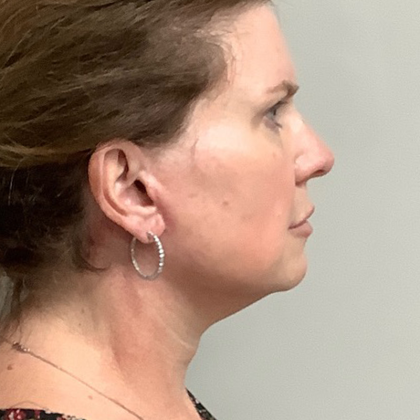 HourLift Before & After Patient #10700