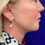 Neck Lift Before & After Patient #10659