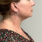 Neck Liposuction Before & After Patient #10705