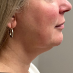 HourLift Before & After Patient #10736