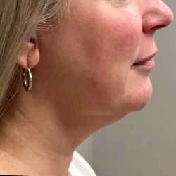 HourLift Before & After Patient #10736