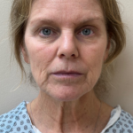 HourLift Before & After Patient #10713