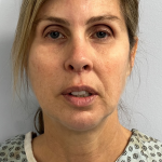 HourLift Before & After Patient #10743