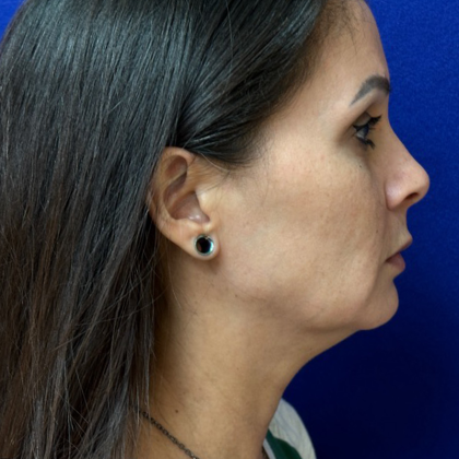 Mini Facelift Before & After Patient #10749
