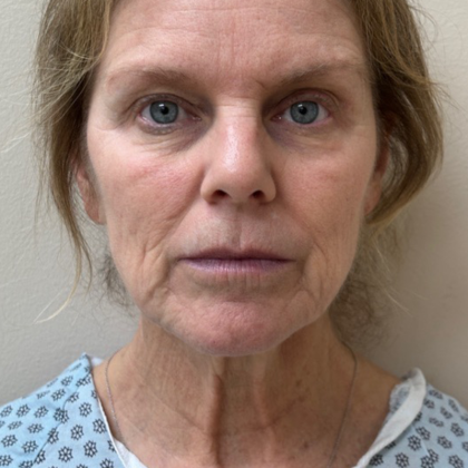 HourLift Before & After Patient #10713