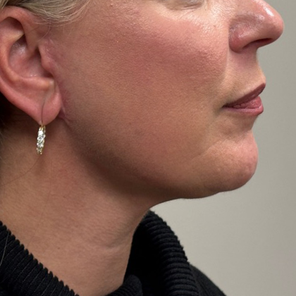 HourLift Before & After Patient #10736