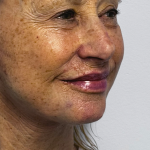 HourLift Before & After Patient #10739