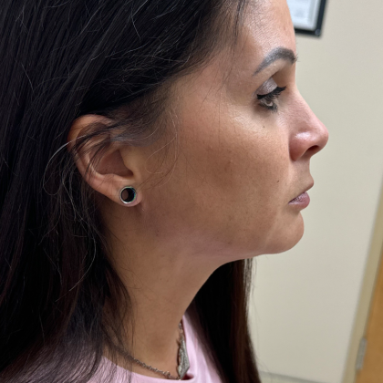 Mini Facelift Before & After Patient #10749