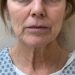 Neck Lift Before & After Patient #10718