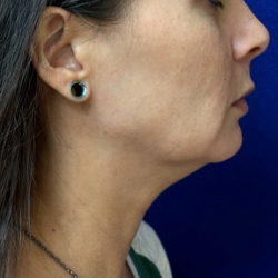Neck Lift Before & After Patient #10754