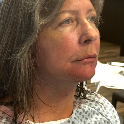 HourLift Before & After Patient #10748