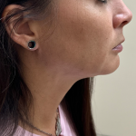 Neck Lift Before & After Patient #10754