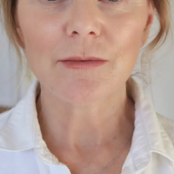 Neck Lift Before & After Patient #10718