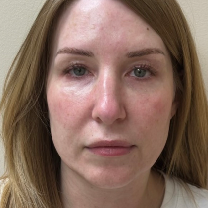 HourLift Before & After Patient #10803