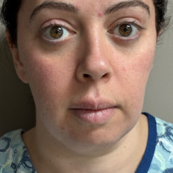 HourLift Before & After Patient #10807