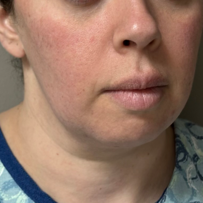 Neck Lift Before & After Patient #10814