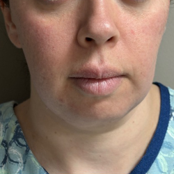Neck Lift Before & After Patient #10814