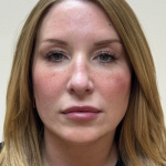 HourLift Before & After Patient #10803