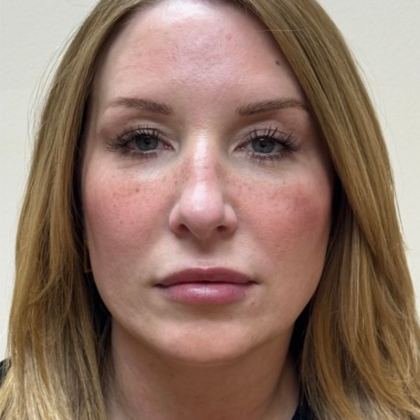 HourLift Before & After Patient #10803