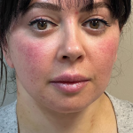 HourLift Before & After Patient #10807