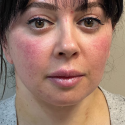 HourLift Before & After Patient #10807
