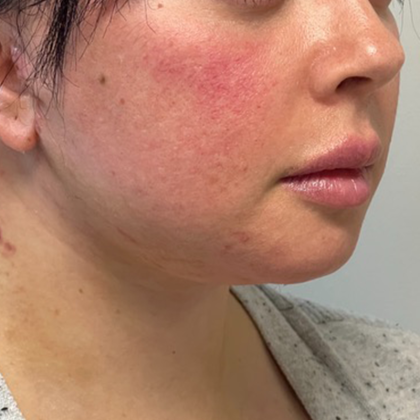 Neck Lift Before & After Patient #10814