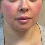 Neck Lift Before & After Patient #10814