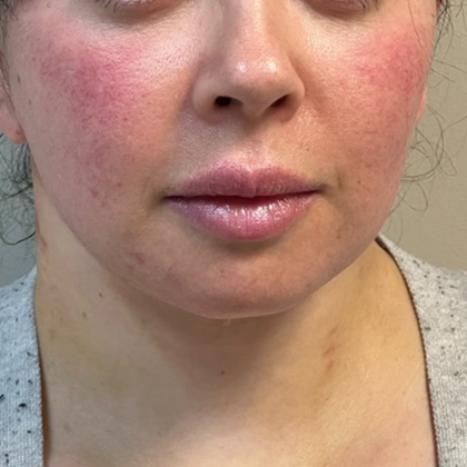 Neck Lift Before & After Patient #10814