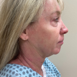HourLift Before & After Patient #10802