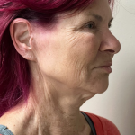 HourLift Before & After Patient #10788