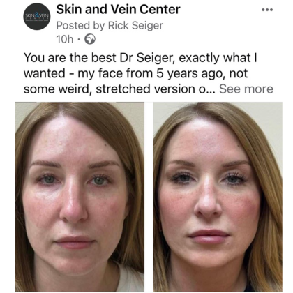 HourLift Before & After Patient #10803