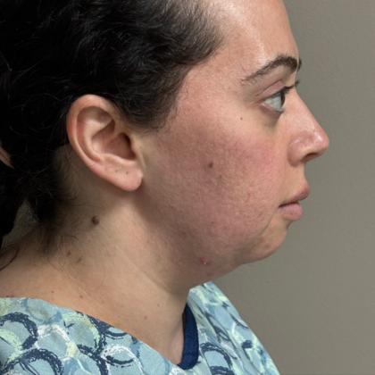 HourLift Before & After Patient #10807