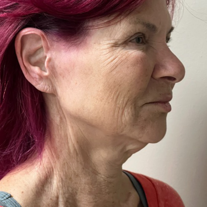 HourLift Before & After Patient #10788