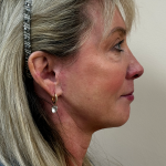 HourLift Before & After Patient #10802