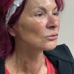 HourLift Before & After Patient #10788