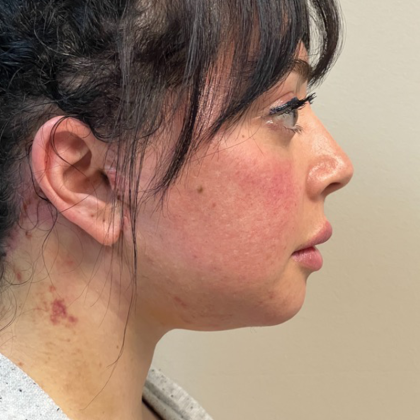 HourLift Before & After Patient #10807