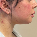 Neck Lift Before & After Patient #10814