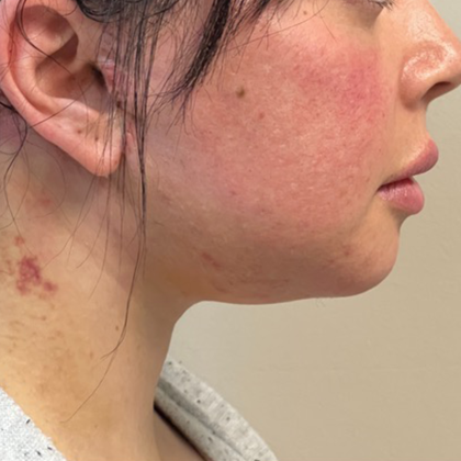 Neck Lift Before & After Patient #10814