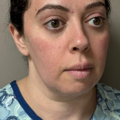HourLift Before & After Patient #10807