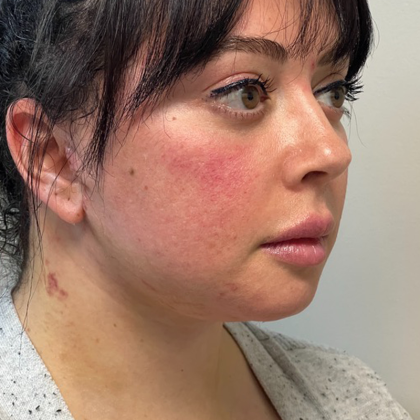 HourLift Before & After Patient #10807