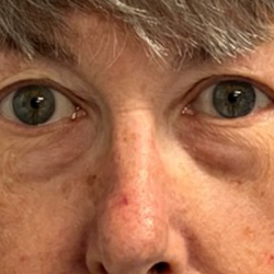 Blepharoplasty Before & After Patient #10865