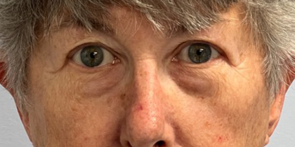 Blepharoplasty Before & After Patient #10865