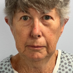 HourLift Before & After Patient #10860