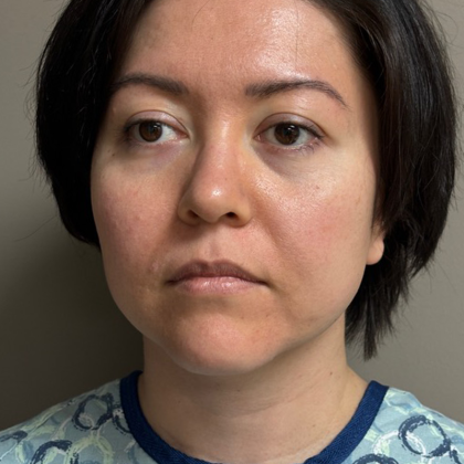 HourLift Before & After Patient #10868