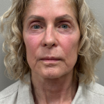 HourLift Before & After Patient #10874